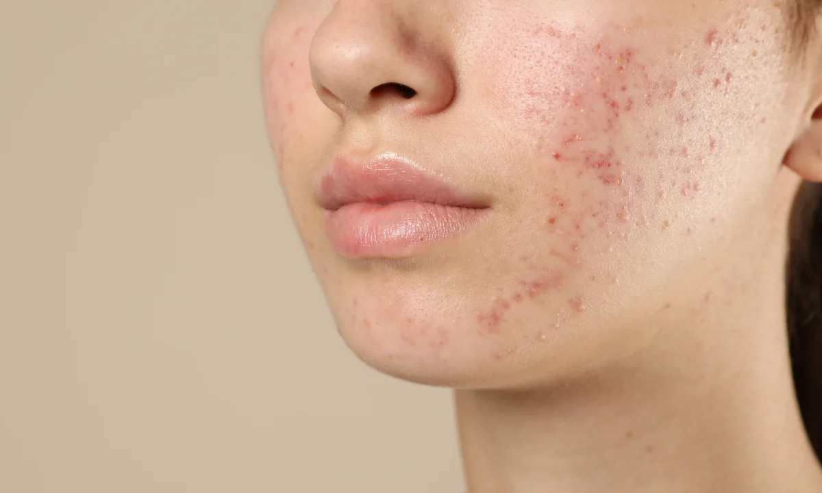 Best Skincare Routine For Acne Prone Skin That Works